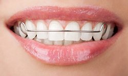 Hawley Retainers | St. Louis Orthodontist
