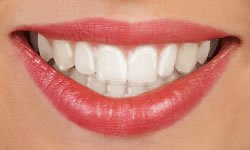 Clear Fixed Retainers | Orthodontist in St. Louis
